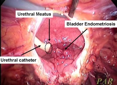Foto de videolaparoscopia removendo nódulo de endometriose na bexiga. 