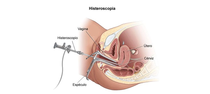 histerosocopia