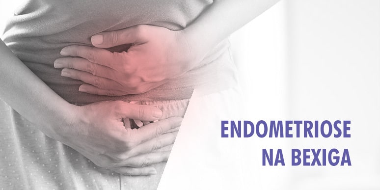 Endometriose na Bexiga: O que é, quais os sintomas e como tratar.