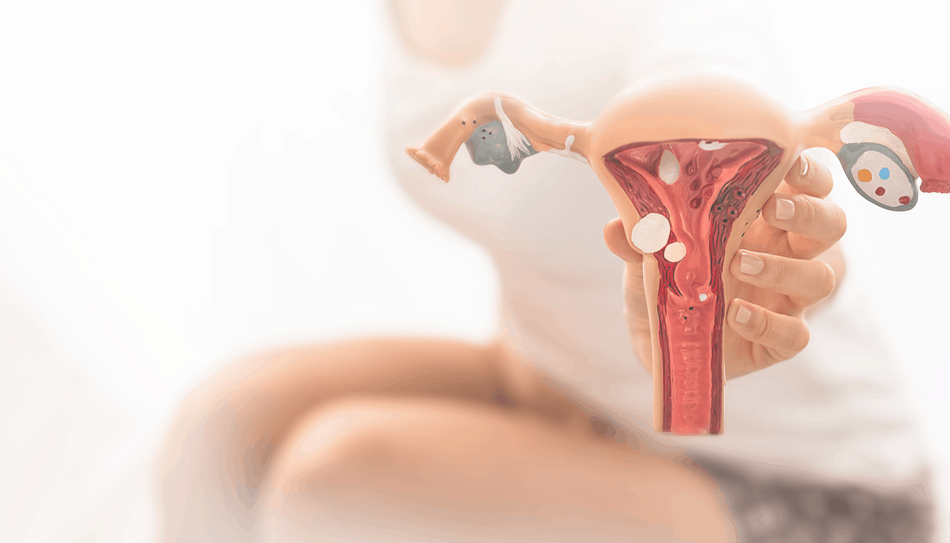 Endometriose Ovariana